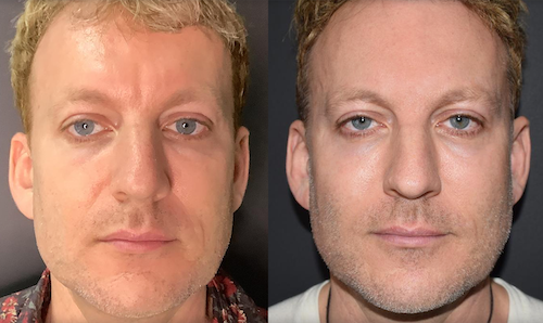 under eye filler dark circle treatment before after mississauga oakville